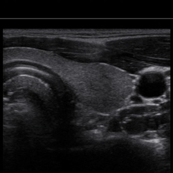 Tiroides con SDMR