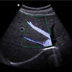 Abdomen con DPDI