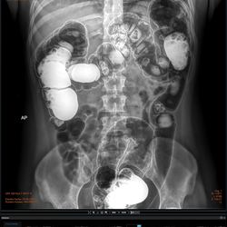 Colon 1