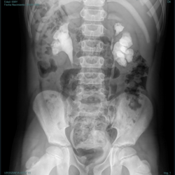 Urografía